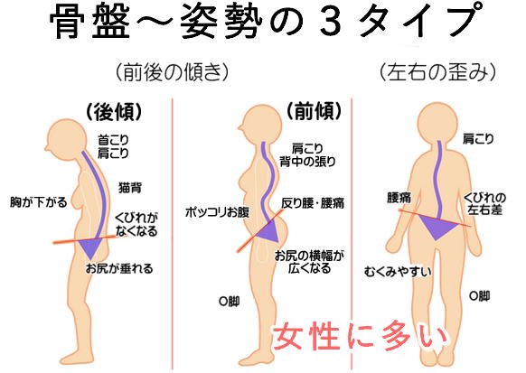 骨盤と姿勢の3タイプ